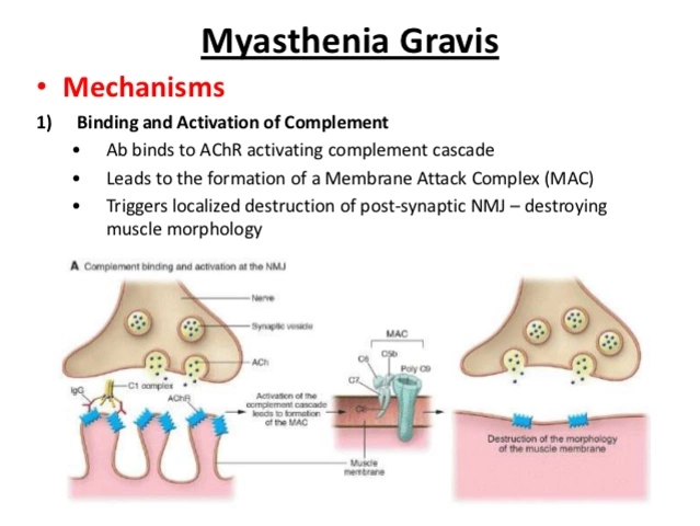 Myasthenia Gravis and Swallowing Issues: Tips for Easier Eating
