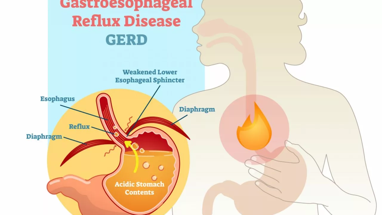 Tympanites and Gastroesophageal Reflux Disease (GERD): Understanding the Link