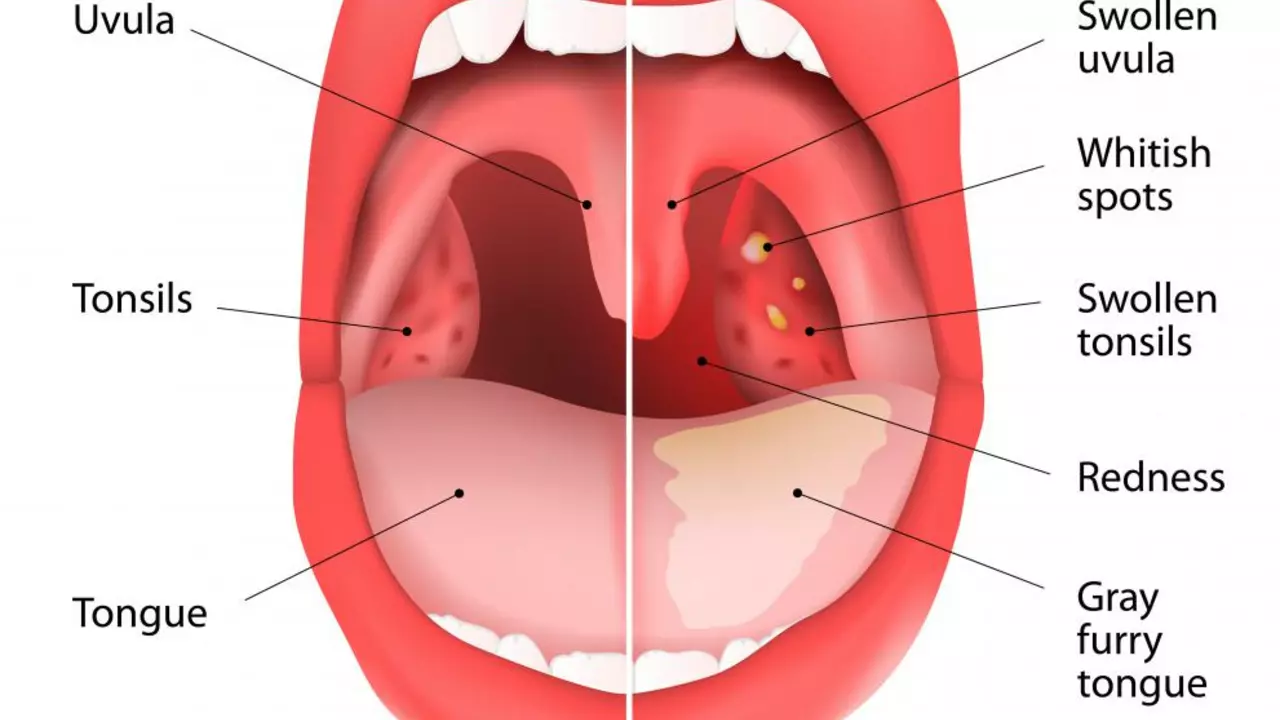 Can Tonsillitis Cause Bad Breath? What You Need to Know